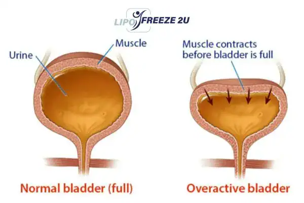 diagram of overactive bladder treatment Chingford