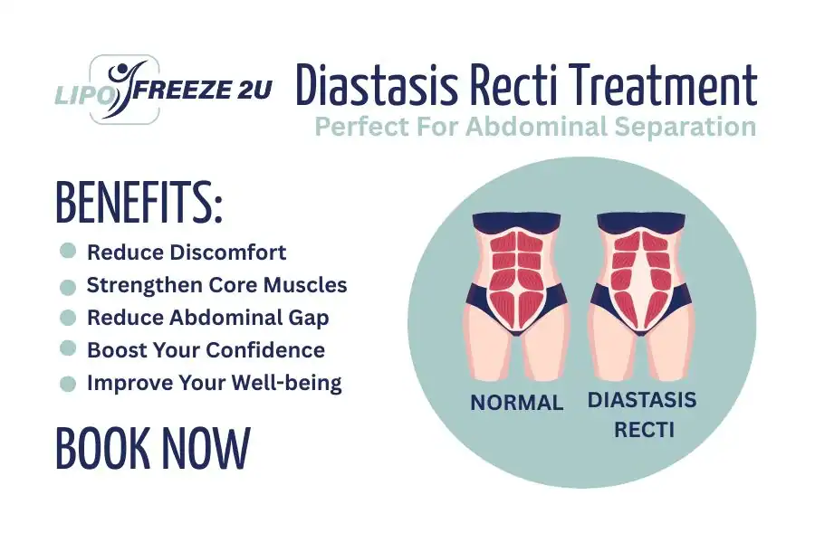How Long Will It Take to See Improvements in Diastasis Recti Chingford