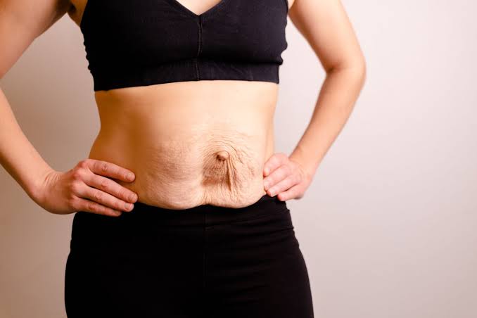 Is Surgery Really the Only Way to Repair Diastasis Recti Chingford?