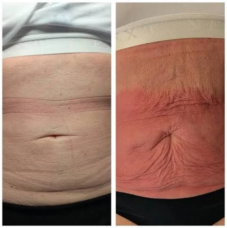 How Does RF Microneedling Improve Crepey, Thin and Uneven Skin Texture Chingford?