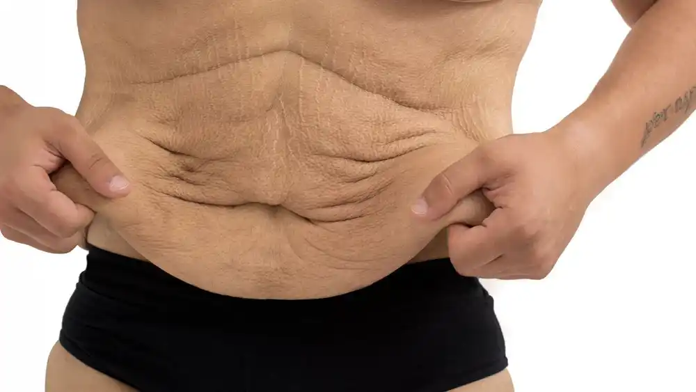 RF Microneedling for Loose Skin: How Can It Help Tighten and Reshape the Skin Chingford?